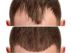 Rediscover Your Confidence: The Guide to Hair Transplantation